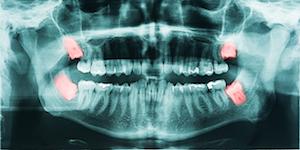 Wisdom Teeth Removal - NORTHSIDE FAMILY DENTAL - GUNGAHLIN - CANBERRA