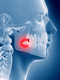 Wisdom Tooth Removal Canberra